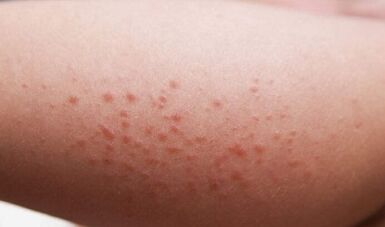 zunanje manifestacije prisotnosti parazitov v telesu